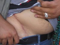 Gunshot wound