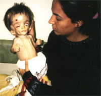 A baby in Iraq is deformed